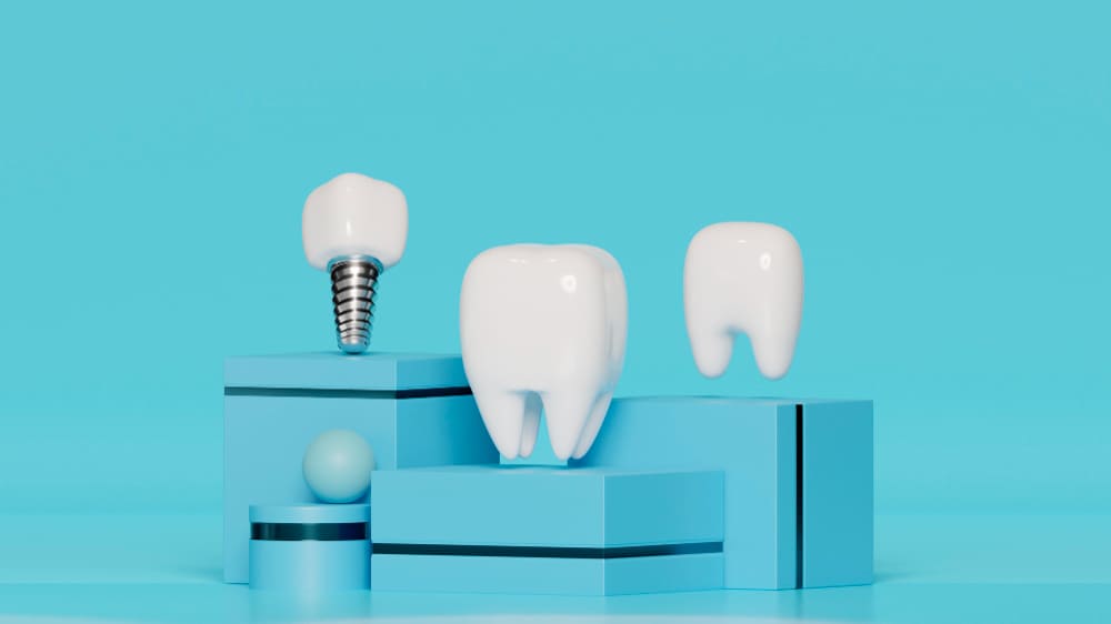 Todo lo que necesitas saber sobre los implantes dentales.